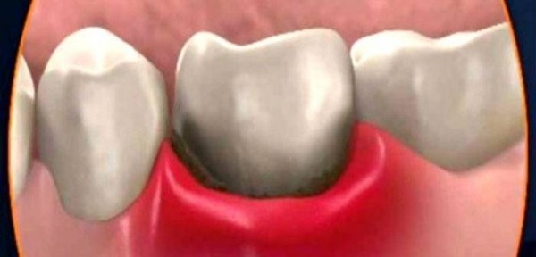 Что делать, если очень сильно болит зуб