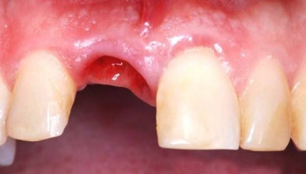 Что делать, если очень сильно болит зуб
