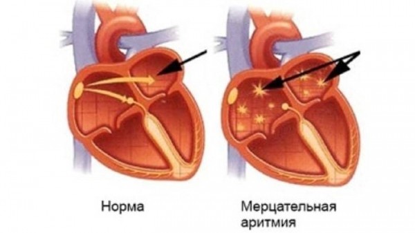 Аритмия сердца - причины и признаки болезни. Симптомы и лечение