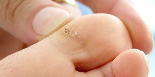 Сухая мозоль на пальце ноги: лечение