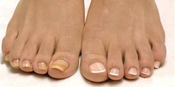Мазь от грибка ногтей: лечение и отзывы